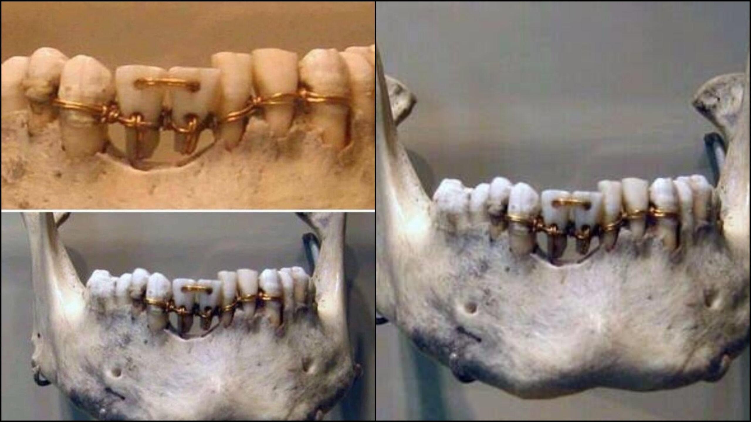 Incredible dental work found on a 4,000-year-old mummy of Ancient Egypt